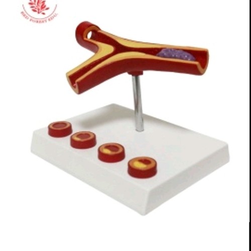 Medical Tech General Trading - Arteriosclerosis zone vascular model